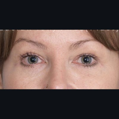 After blepharoplasty, case 1, view 1 view