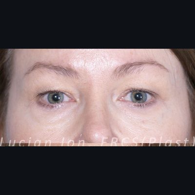 Before blepharoplasty, case 1, view 1 view