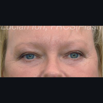 After blepharoplasty, case 1, view 2 view