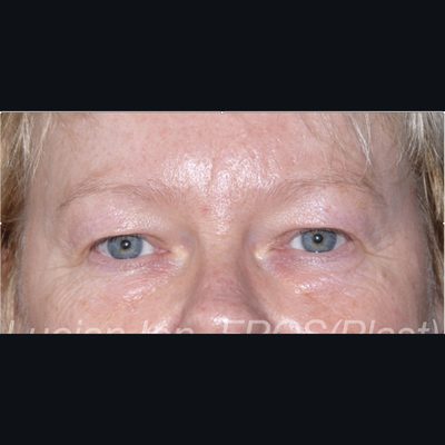 Before blepharoplasty, case 1, view 2 view