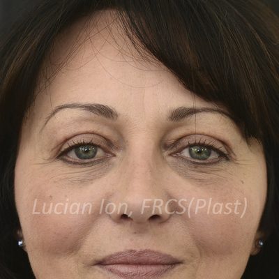 After blepharoplasty, case 2, view 1 view