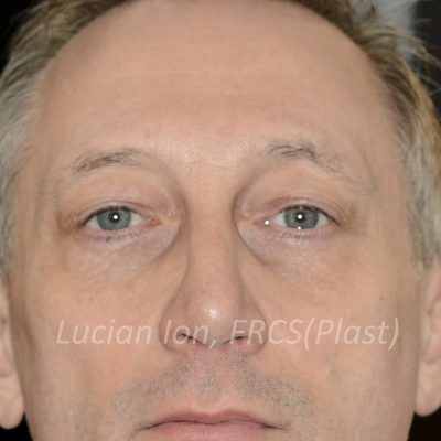 After blepharoplasty, case 3, front view
