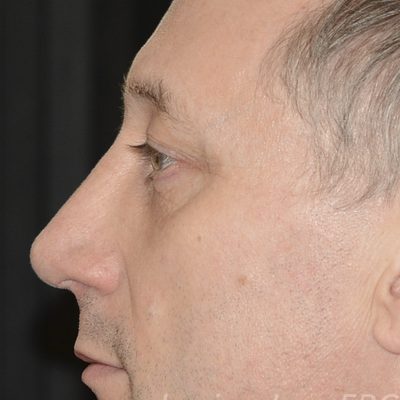 After blepharoplasty, case 3, profile view