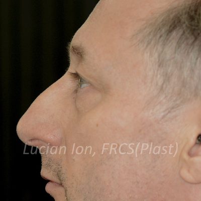 Before blepharoplasty, case 3, profile view