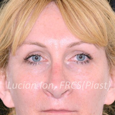 After blepharoplasty, case 4, front view