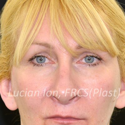Before blepharoplasty, case 4, front view