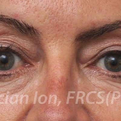 After blepharoplasty, case 5, front view