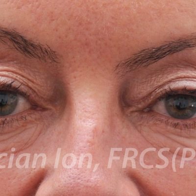 Before blepharoplasty, case 5, front view