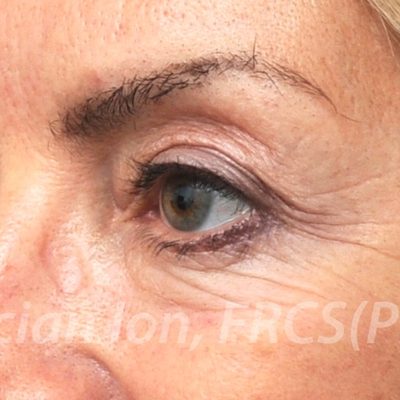 After blepharoplasty, case 5, oblique view
