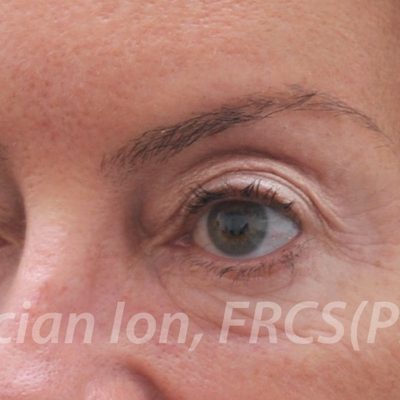 Before blepharoplasty, case 5, oblique view