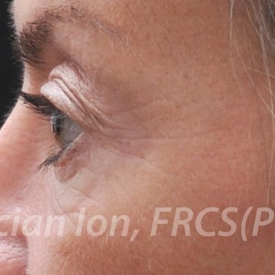 Before blepharoplasty, case 5, profile view