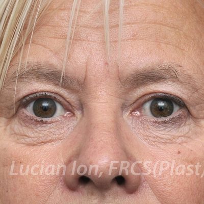 After blepharoplasty, case 6, view 1 view