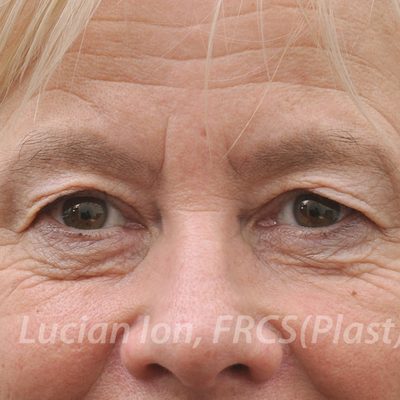 Before blepharoplasty, case 6, view 1 view