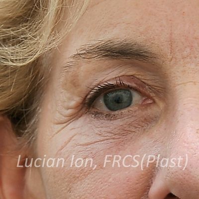 After blepharoplasty, case 7, view 1 view
