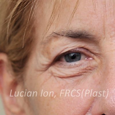 Before blepharoplasty, case 7, view 1 view