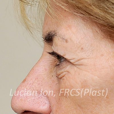 Before blepharoplasty, case 7, view 2 view