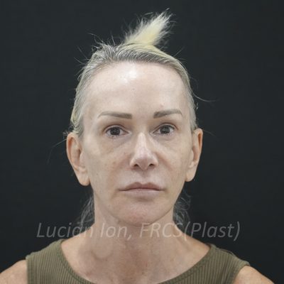 After brow lift, case 3, front view