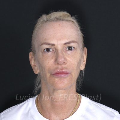 Before brow lift, case 3, front view