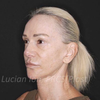 After brow lift, case 3, oblique view