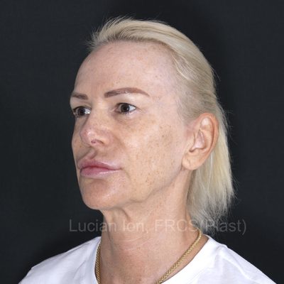 Before brow lift, case 3, oblique view