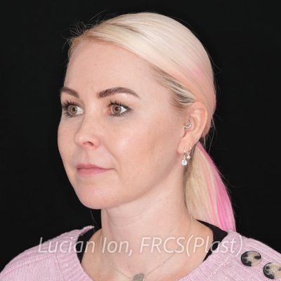 After deep contouring neck lift, case 1, oblique view