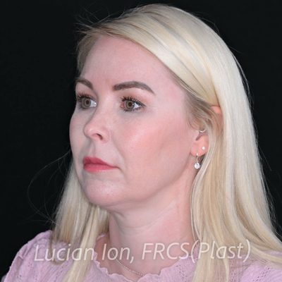 Before deep contouring neck lift, case 1, oblique view