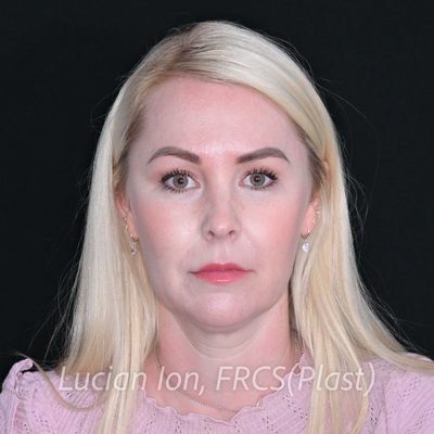 Before deep contouring neck lift, case 1, front view