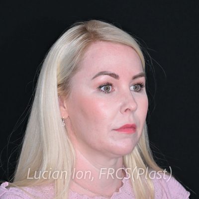 Before deep contouring neck lift, case 1, oblique view