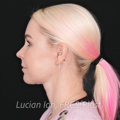 After deep contouring neck lift, case 1, profile view