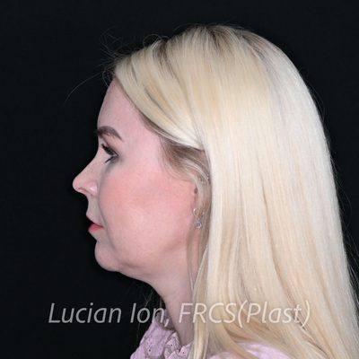 Before deep contouring neck lift, case 1, profile view