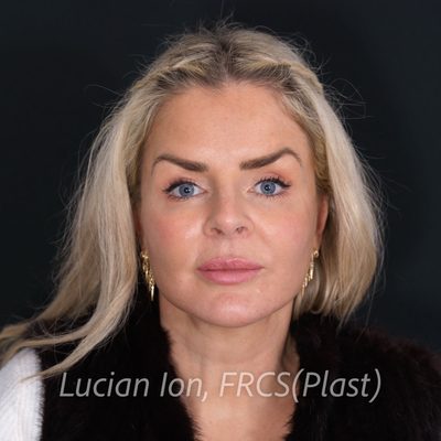 After deep contouring neck lift, case 2, front view