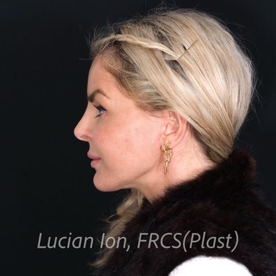 After deep contouring neck lift, case 2, profile view