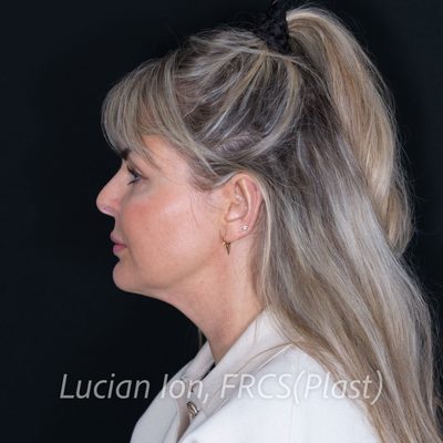 Before deep contouring neck lift, case 2, profile view
