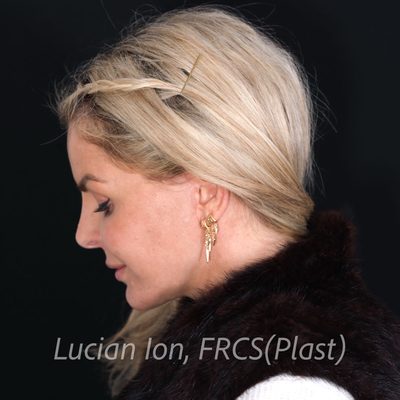After deep contouring neck lift, case 2, profile, neck flexed view