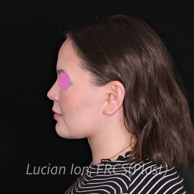 After deep contouring neck lift, case 3, profile view
