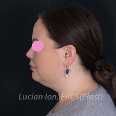 Before deep contouring neck lift, case 3, profile view