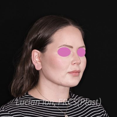 After deep contouring neck lift, case 3, oblique view
