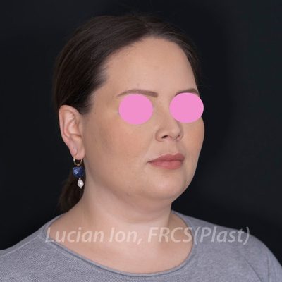 Before deep contouring neck lift, case 3, oblique view