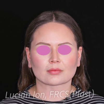 After deep contouring neck lift, case 3, front view