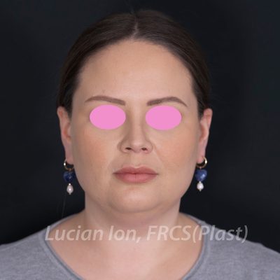Before deep contouring neck lift, case 3, front view