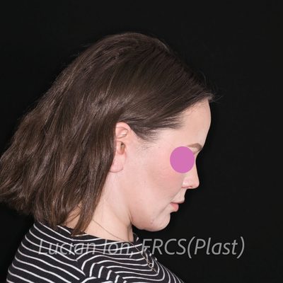 After deep contouring neck lift, case 3, profile, neck flexed view