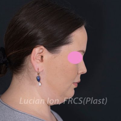 Before deep contouring neck lift, case 3, profile, neck flexed view