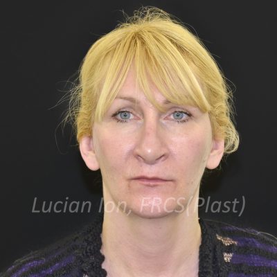 Before deep contouring neck lift, case 4, front view