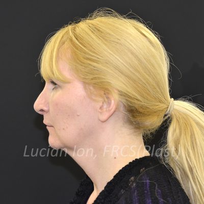 Before deep contouring neck lift, case 4, profile view