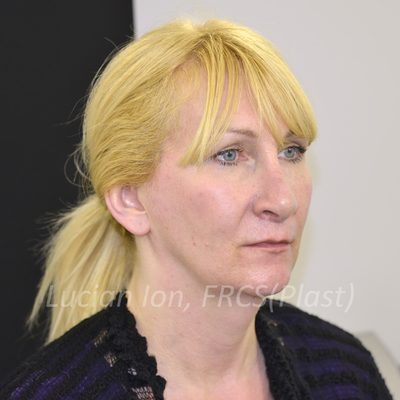 Before deep contouring neck lift, case 4, oblique view