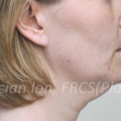 Before deep contouring neck lift, case 6, view 1 view
