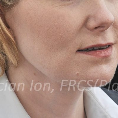 After deep contouring neck lift, case 6, view 2 view