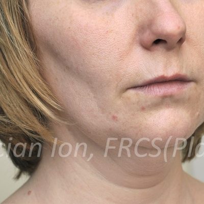 Before deep contouring neck lift, case 6, view 2 view