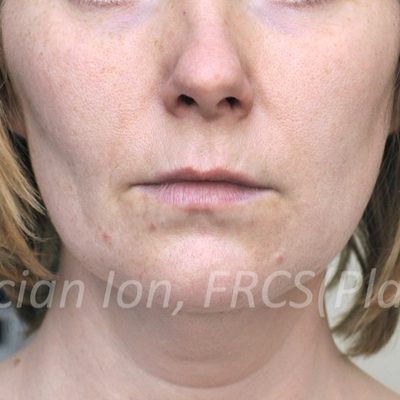 Before deep contouring neck lift, case 6, view 3 view