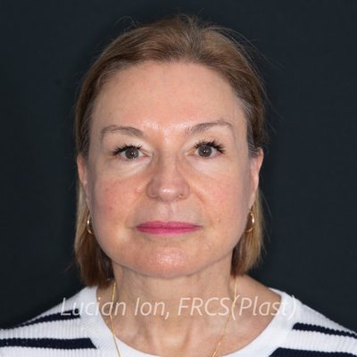 After deep contouring neck lift, case 7, front view